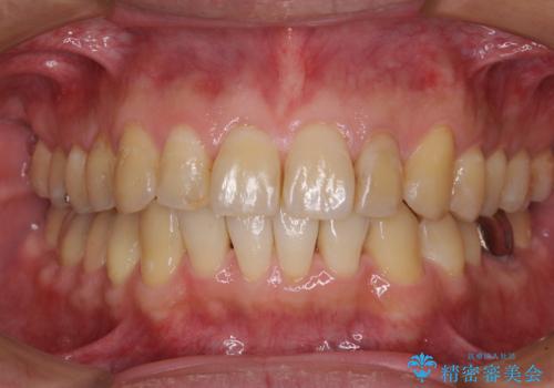 前歯のデコボコと下顎の八重歯　インビザラインによる矯正治療