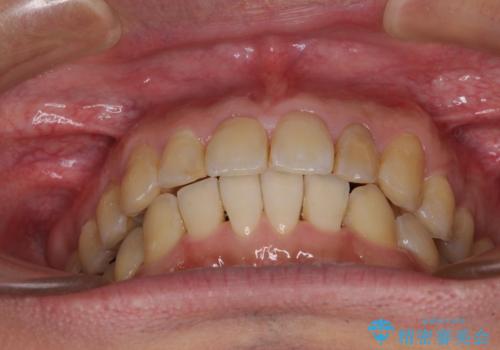 前歯のデコボコと下顎の八重歯 インビザラインによる矯正治療の治療後