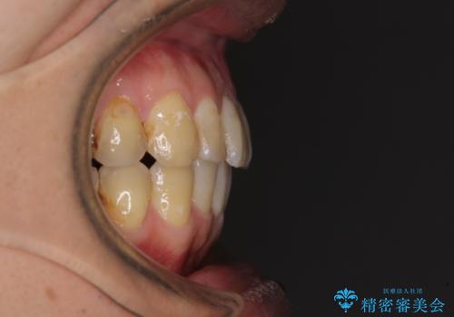 前歯のデコボコと下顎の八重歯　インビザラインによる矯正治療の治療後