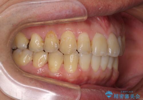 前歯のデコボコと下顎の八重歯 インビザラインによる矯正治療の治療後