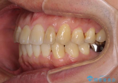 前歯のデコボコと下顎の八重歯 インビザラインによる矯正治療の治療後