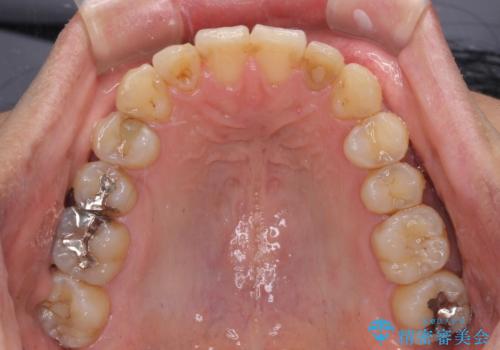 前歯のデコボコと下顎の八重歯 インビザラインによる矯正治療の治療後