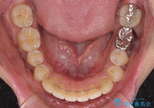 前歯のデコボコと下顎の八重歯 インビザラインによる矯正治療の治療後