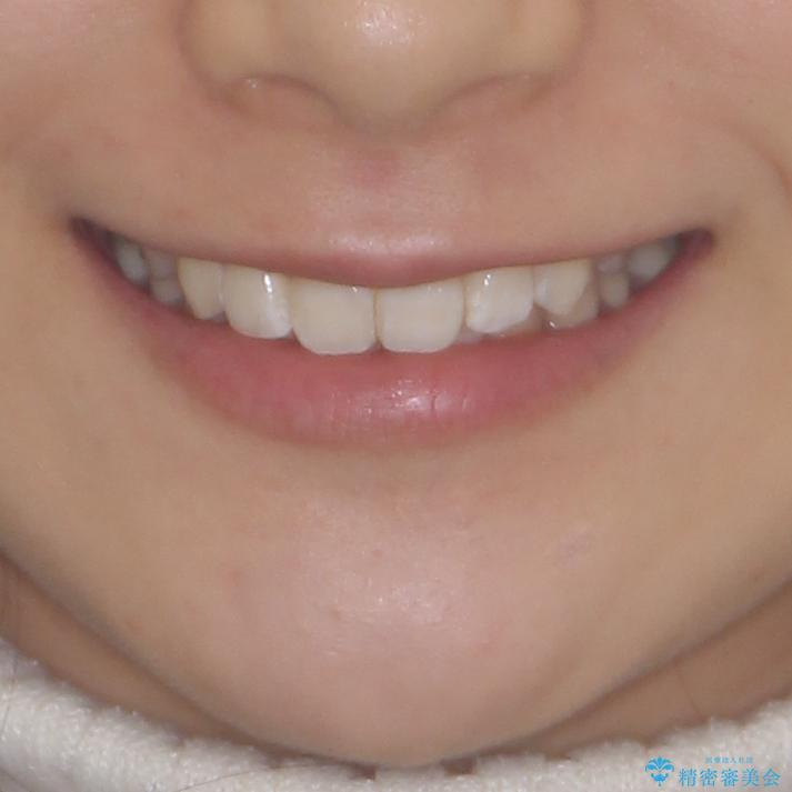 上下前歯の叢生をインビザラインできれいにの治療後（顔貌）