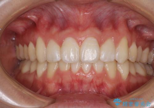 上下前歯の叢生をインビザラインできれいにの症例 治療後