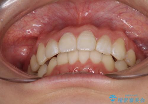 上下前歯の叢生をインビザラインできれいにの治療後