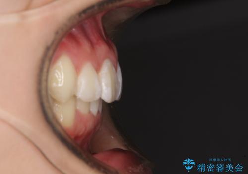 上下前歯の叢生をインビザラインできれいにの治療後