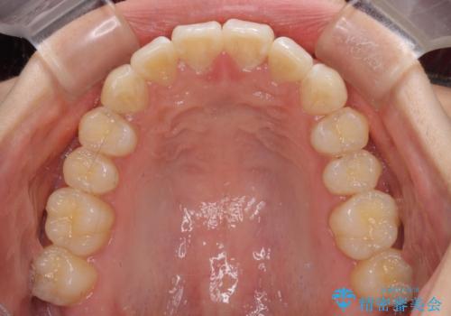 上下前歯の叢生をインビザラインできれいにの治療後