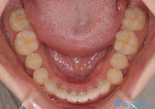 上下前歯の叢生をインビザラインできれいにの治療後