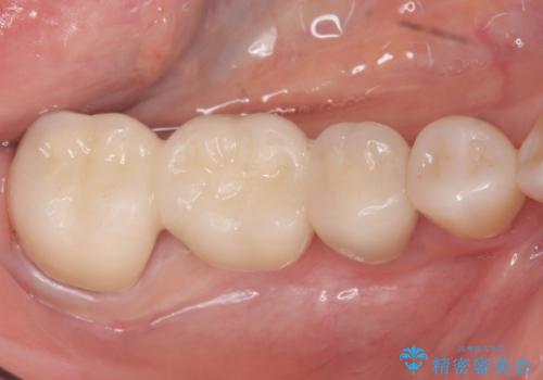 奥歯 抜歯してブリッジに 50代女性の治療後