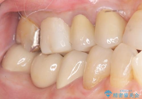 奥歯 抜歯してブリッジに 50代女性の治療後