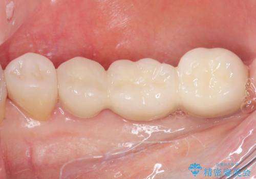 奥歯 抜歯してブリッジに 50代女性の症例 治療後