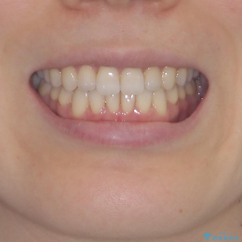 前歯の叢生とオープンバイト　インビザラインでの矯正治療の治療後（顔貌）