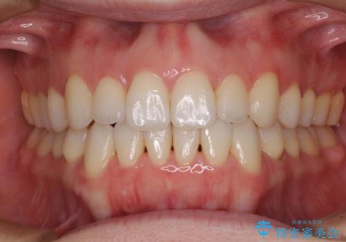 前歯の叢生とオープンバイト　インビザラインでの矯正治療の症例 治療後