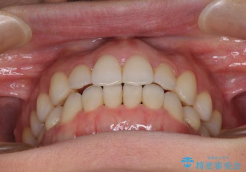 前歯の叢生とオープンバイト　インビザラインでの矯正治療の治療後