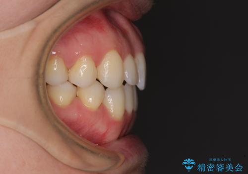 前歯の叢生とオープンバイト インビザラインでの矯正治療の治療後