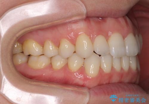 前歯の叢生とオープンバイト インビザラインでの矯正治療の治療後