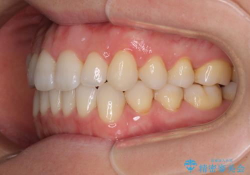 前歯の叢生とオープンバイト　インビザラインでの矯正治療の治療後