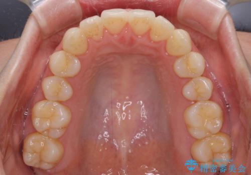 前歯の叢生とオープンバイト インビザラインでの矯正治療の治療後