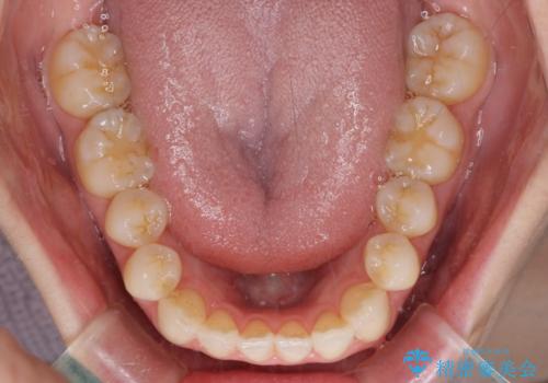 前歯の叢生とオープンバイト インビザラインでの矯正治療の治療後