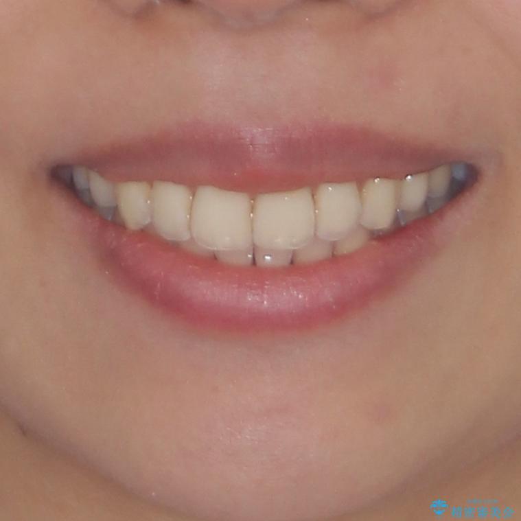 八重歯の再矯正　インビザラインでストレスなく矯正治療の治療後（顔貌）