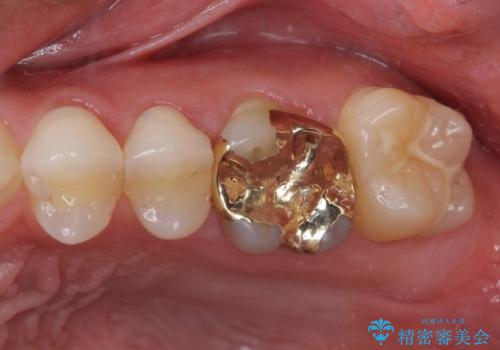 奥歯の詰め物が取れた　継ぎ接ぎだらけの詰め物をゴールドインレーにの症例 治療後
