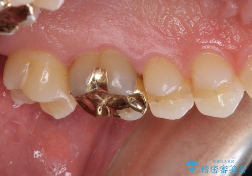 奥歯の詰め物が取れた　継ぎ接ぎだらけの詰め物をゴールドインレーにの治療後