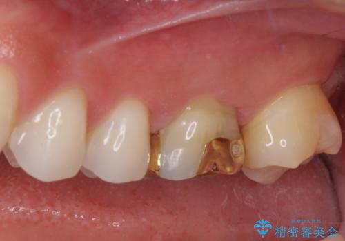 奥歯の詰め物が取れた　継ぎ接ぎだらけの詰め物をゴールドインレーにの治療後