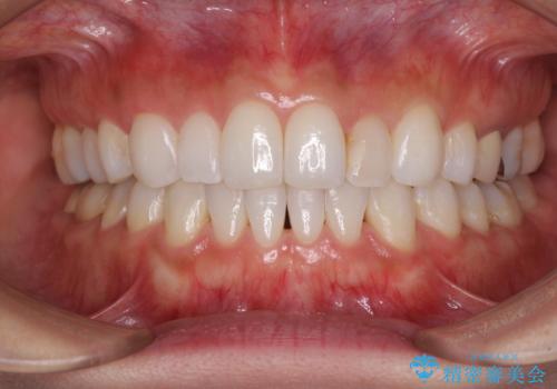 軽度の叢生をインビザライン・ライトで解消