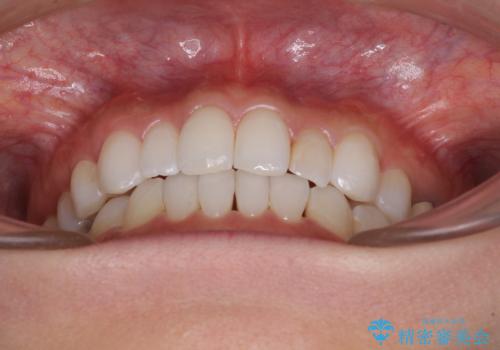 軽度の叢生をインビザライン・ライトで解消の治療後
