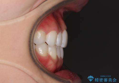 軽度の叢生をインビザライン・ライトで解消の治療後