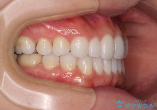 軽度の叢生をインビザライン・ライトで解消の治療後