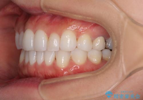 軽度の叢生をインビザライン・ライトで解消の治療後