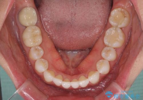 軽度の叢生をインビザライン・ライトで解消の治療後