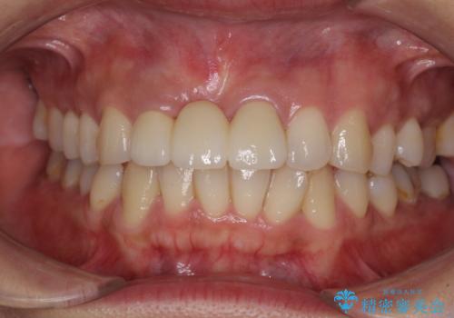 治療途中で放置した前歯 オールセラミックブリッジの治療後