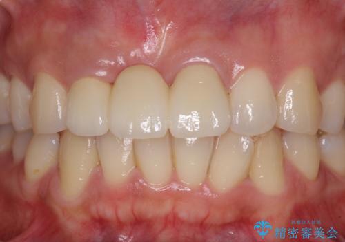 治療途中で放置した前歯 オールセラミックブリッジの治療後