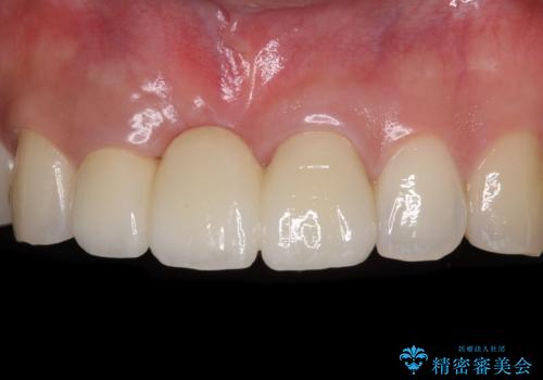 治療途中で放置した前歯 オールセラミックブリッジの治療後
