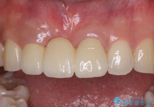 治療途中で放置した前歯 オールセラミックブリッジの治療後