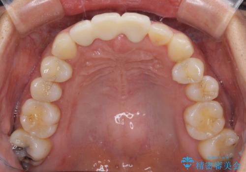 治療途中で放置した前歯 オールセラミックブリッジの治療後