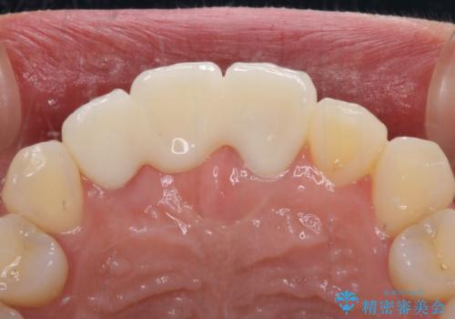 治療途中で放置した前歯 オールセラミックブリッジの治療後