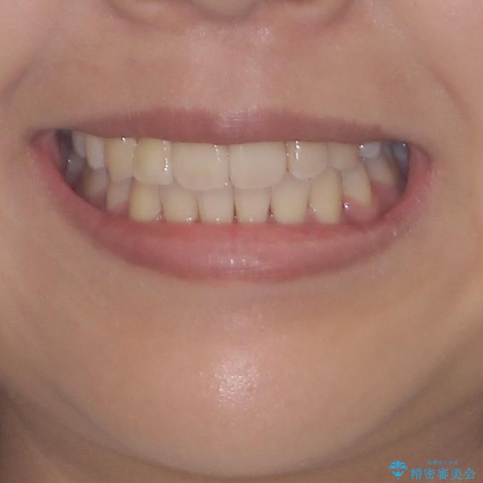 前歯の正中のズレを改善　目立たないワイヤー装置での抜歯矯正の治療後（顔貌）