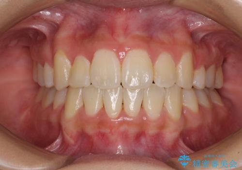前歯の正中のズレを改善　目立たないワイヤー装置での抜歯矯正の治療後