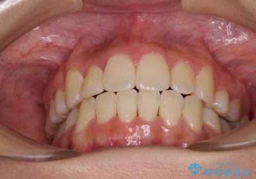 前歯の正中のズレを改善 目立たないワイヤー装置での抜歯矯正の治療後