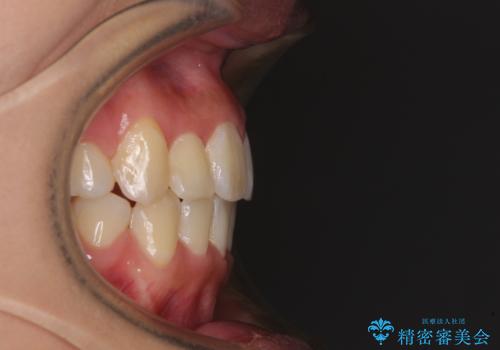 前歯の正中のズレを改善 目立たないワイヤー装置での抜歯矯正の治療後