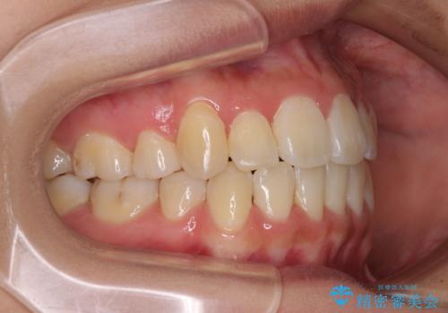 前歯の正中のズレを改善 目立たないワイヤー装置での抜歯矯正の治療後