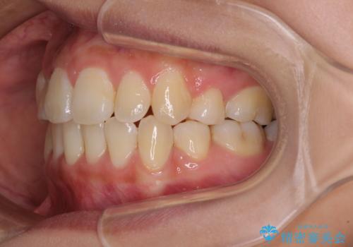 前歯の正中のズレを改善 目立たないワイヤー装置での抜歯矯正の治療後