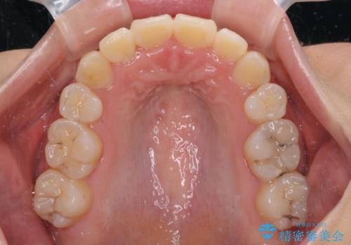 前歯の正中のズレを改善 目立たないワイヤー装置での抜歯矯正の治療後