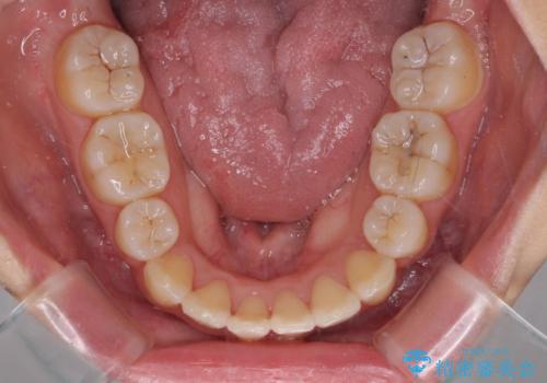 前歯の正中のズレを改善 目立たないワイヤー装置での抜歯矯正の治療後
