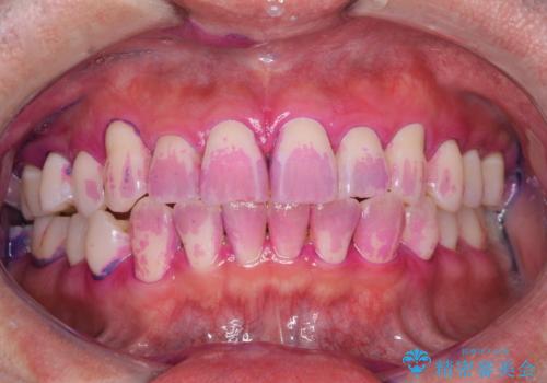 日々の歯磨き残しをPMTCで徹底的に除去の症例 治療前