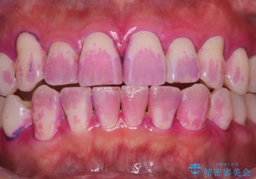 日々の歯磨き残しをPMTCで徹底的に除去の治療前